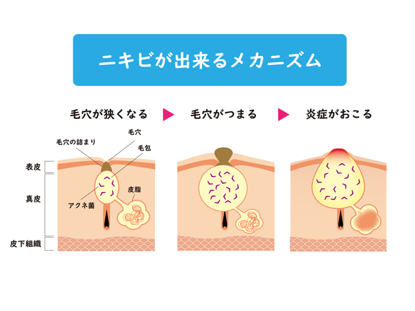 おでこ や 生え際 にできるニキビ ６つの原因と対策 りゅ く Net